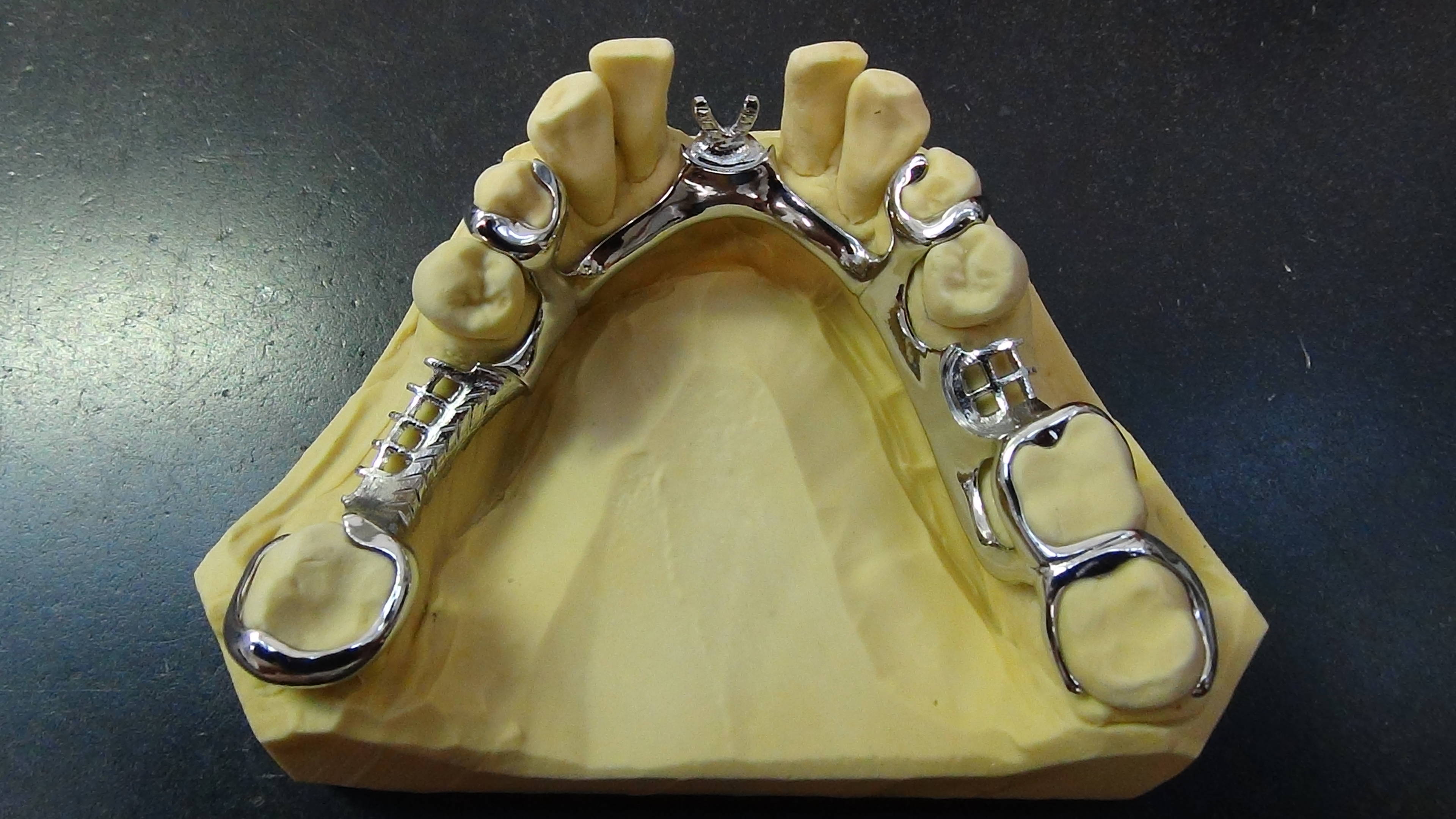 Fertiges UK Bügel Klammergerüst auf Modell