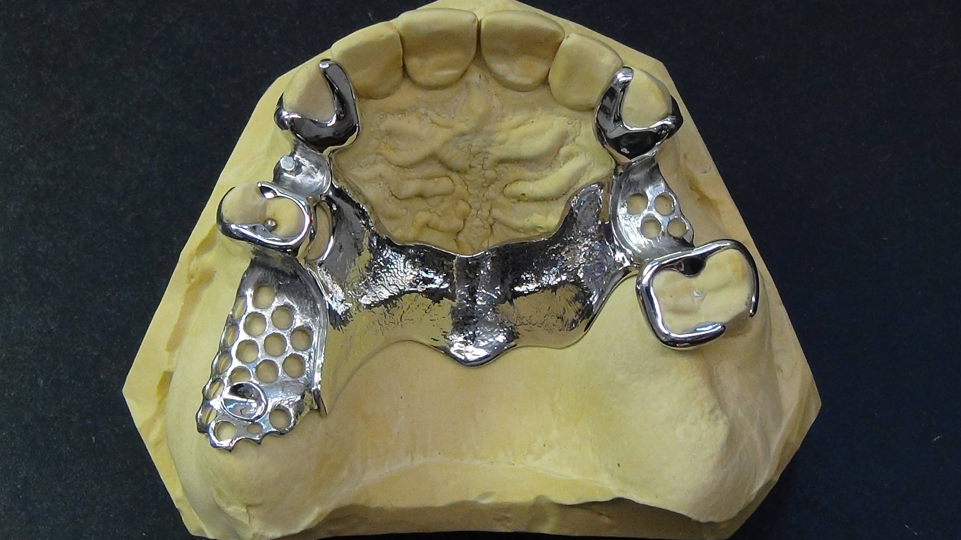 Fertiges OK-Klammergerüst mit Palatinalband auf Modell