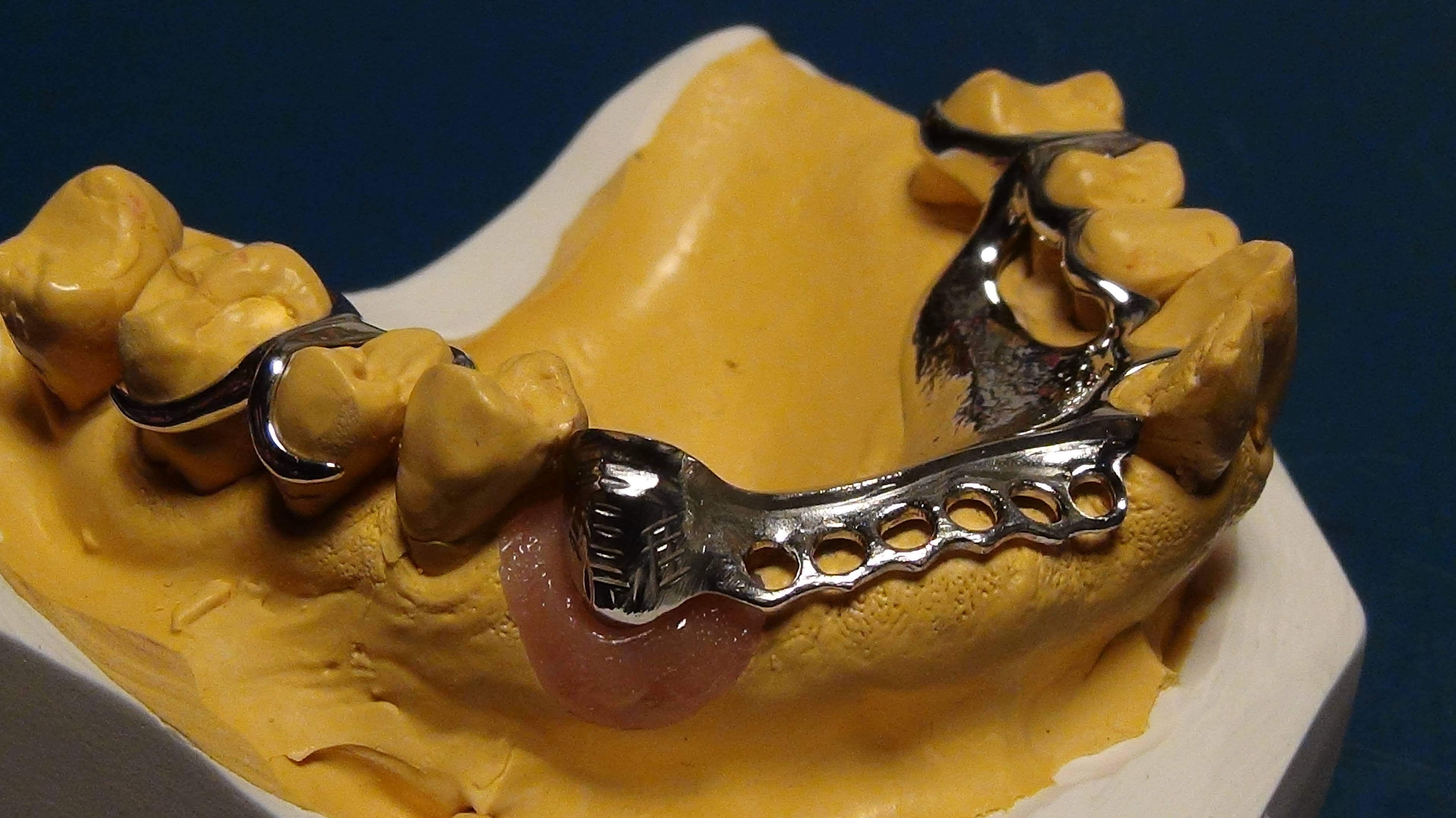 Fertiges OK Hufeisengerüst, auf Zahn23 zahnförmiger Überguss über Anker 