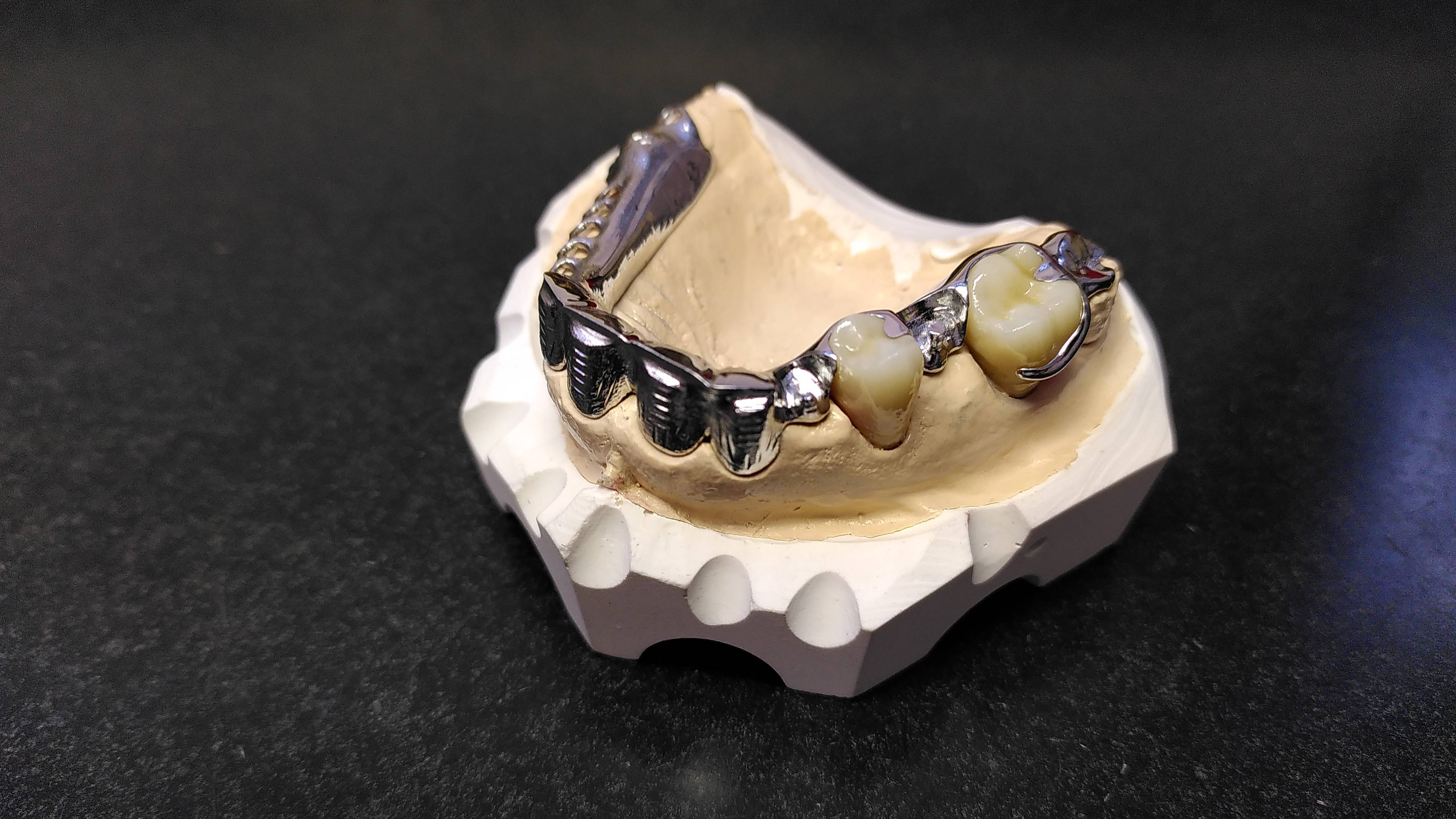 Fertiges OK-Klammergerüst mit Palatinalband auf Modell